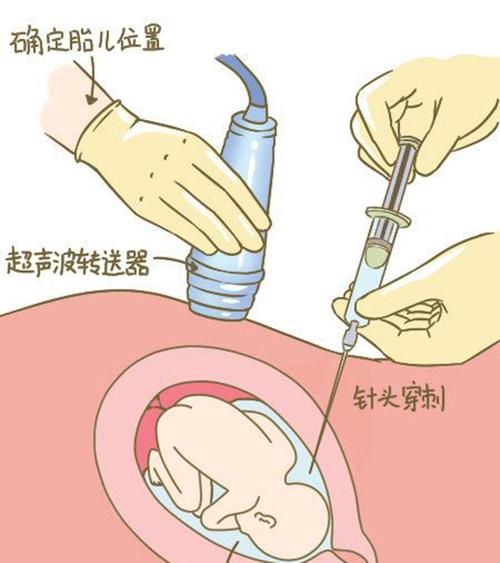 湖州羊水孕期亲子鉴定